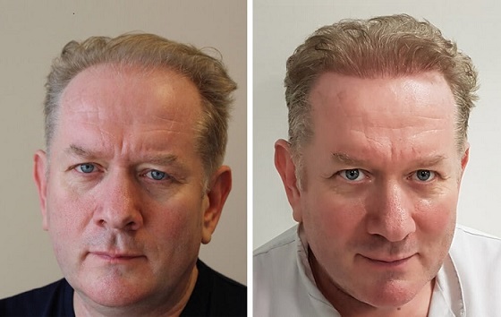 Hair transplant of 2000 grafts - before and after image